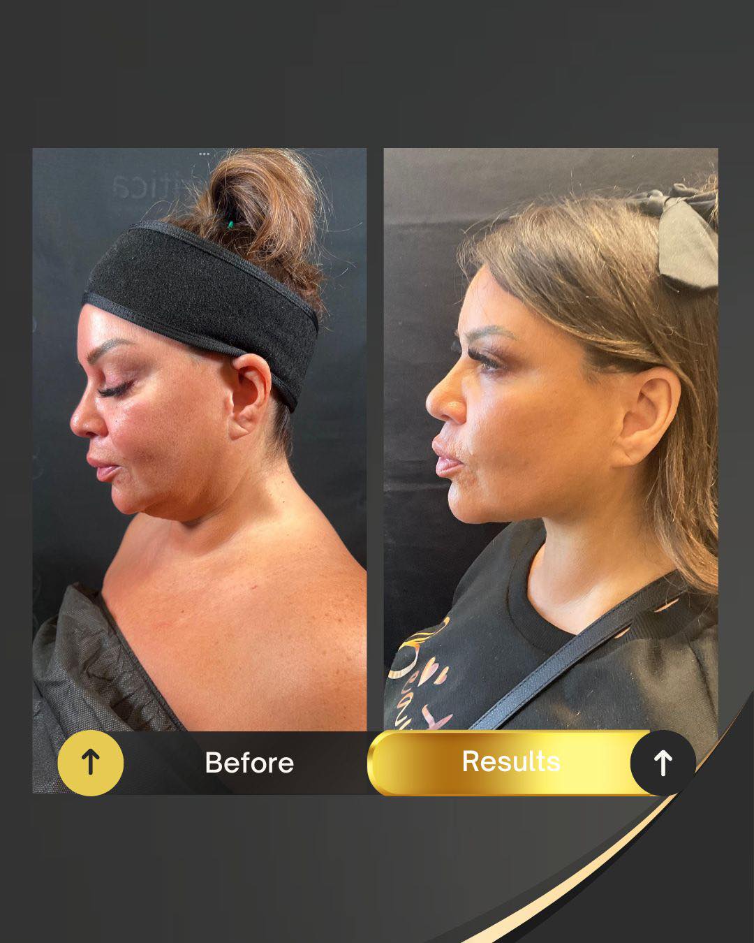 After jawline contouring