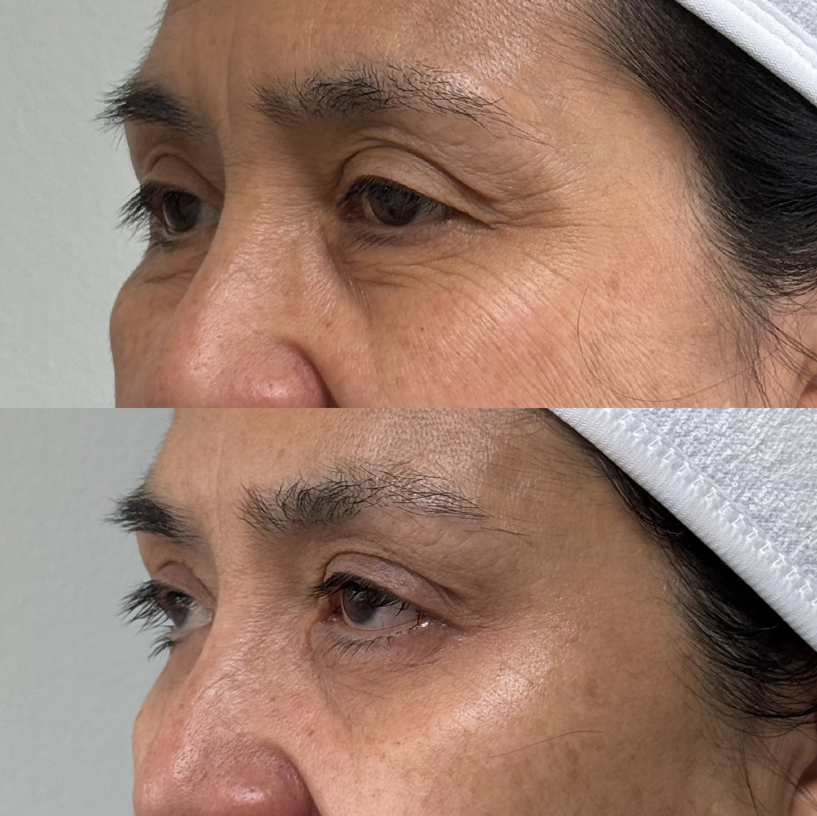 Antes y después · Rejuvenecimiento facial integral
