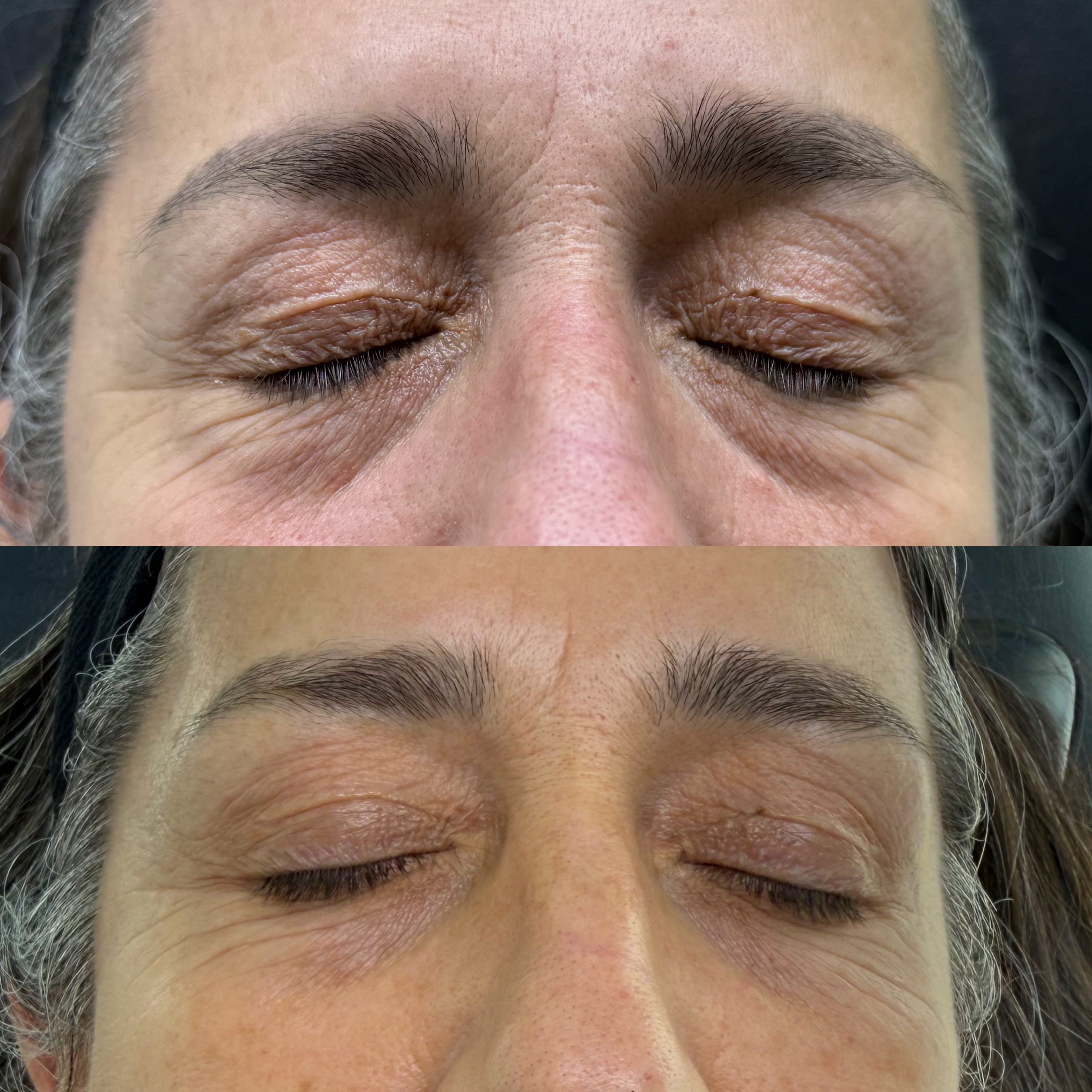 Antes y después · Bioestimulación y luminosidad dérmica