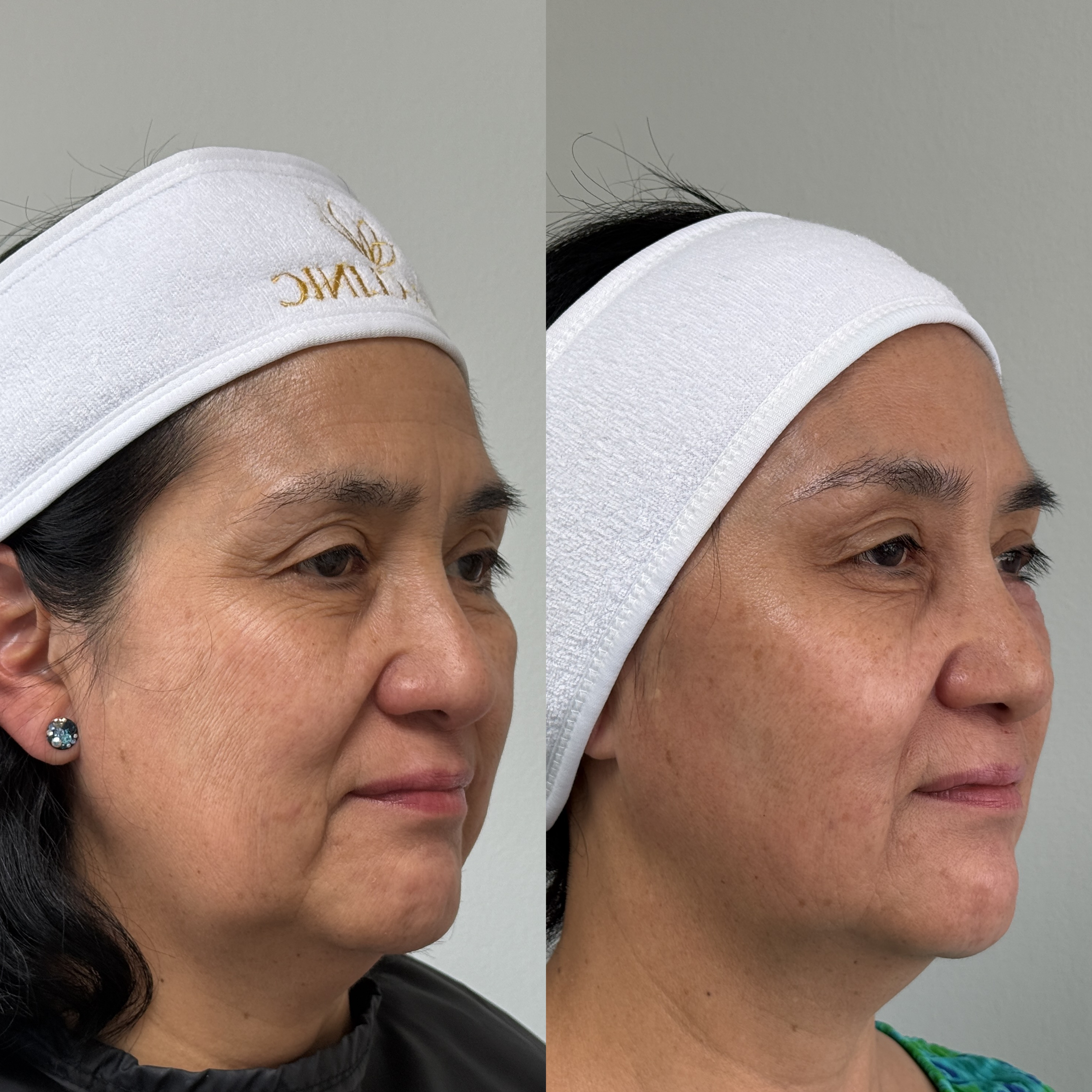 Antes y después · Rejuvenecimiento y luminosidad facial