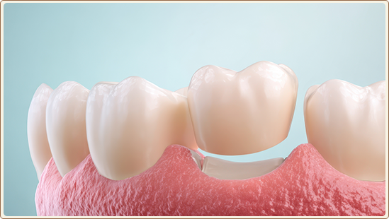 Dental Crowns