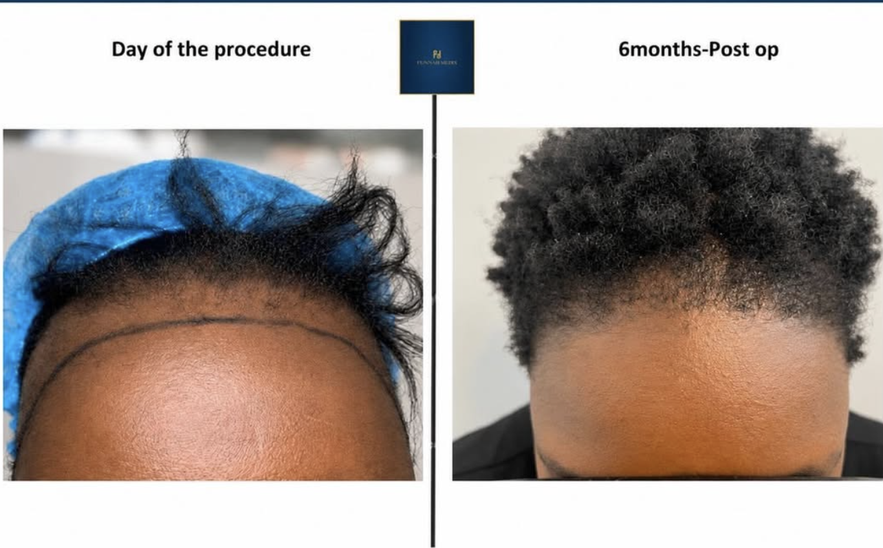 Concept portrait illustrating hair restoration, not a patient result.