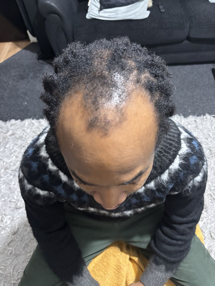 Close crop of a man's frontal hairline, shown as a concern illustration.