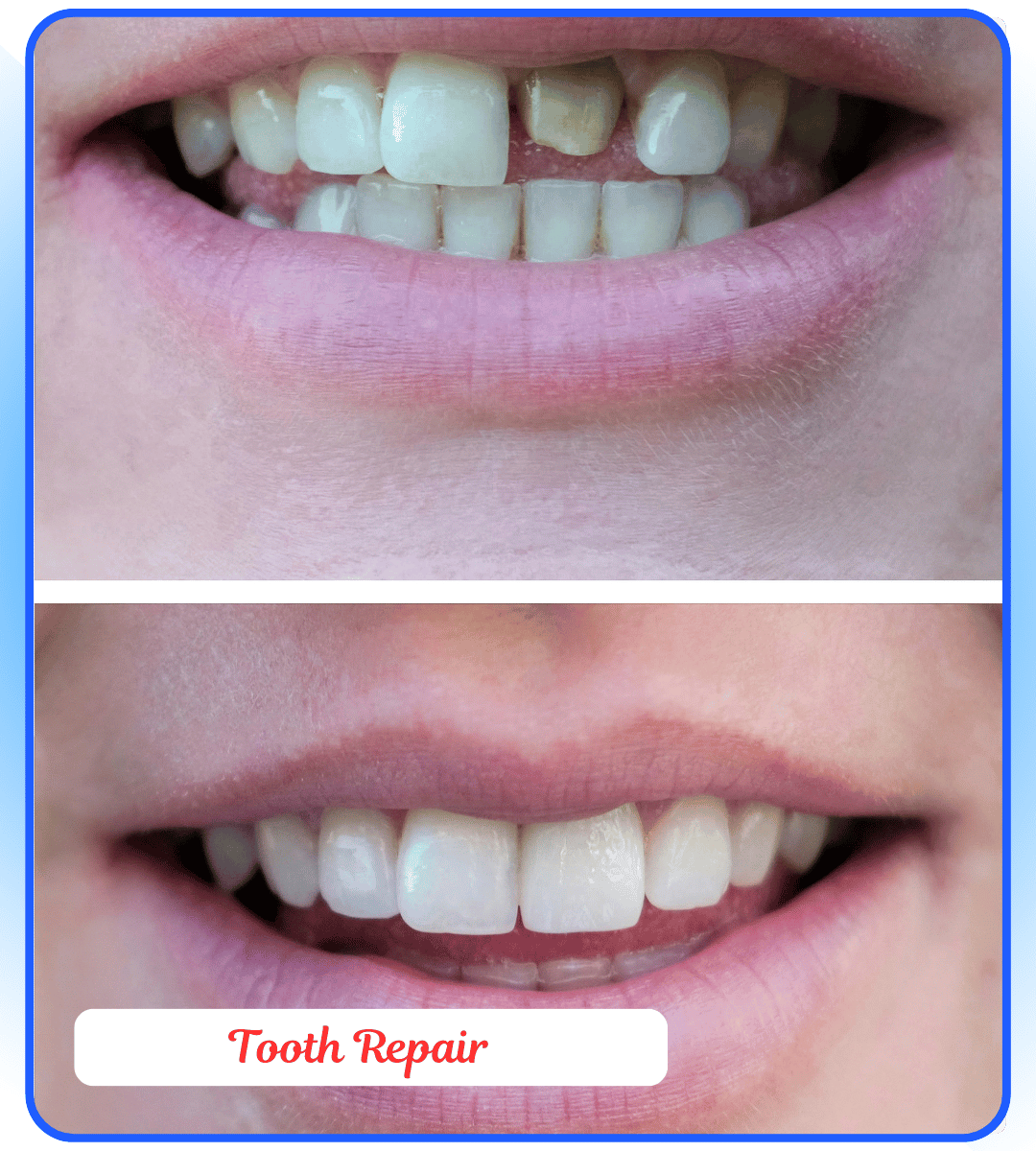 tooth repair
