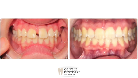 Invisalign before and after results