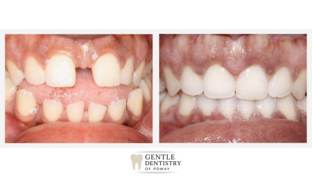 Invisalign before and after - spacing