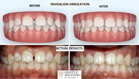 Invisalign before and after - crowding correction