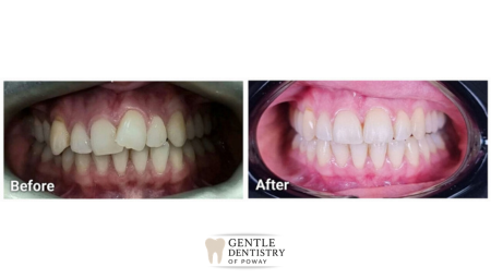 Invisalign smile transformation