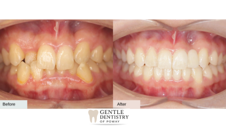 Invisalign before and after - overbite
