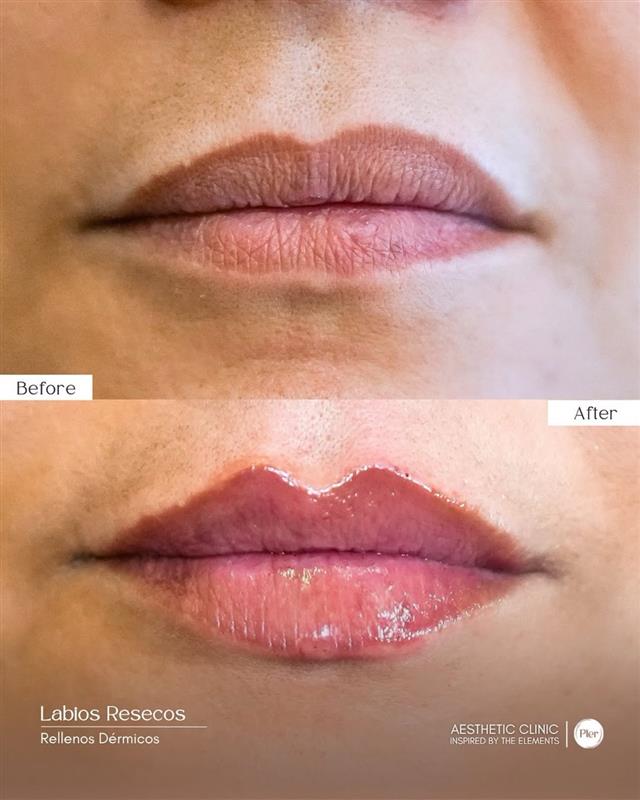 Before and After 1