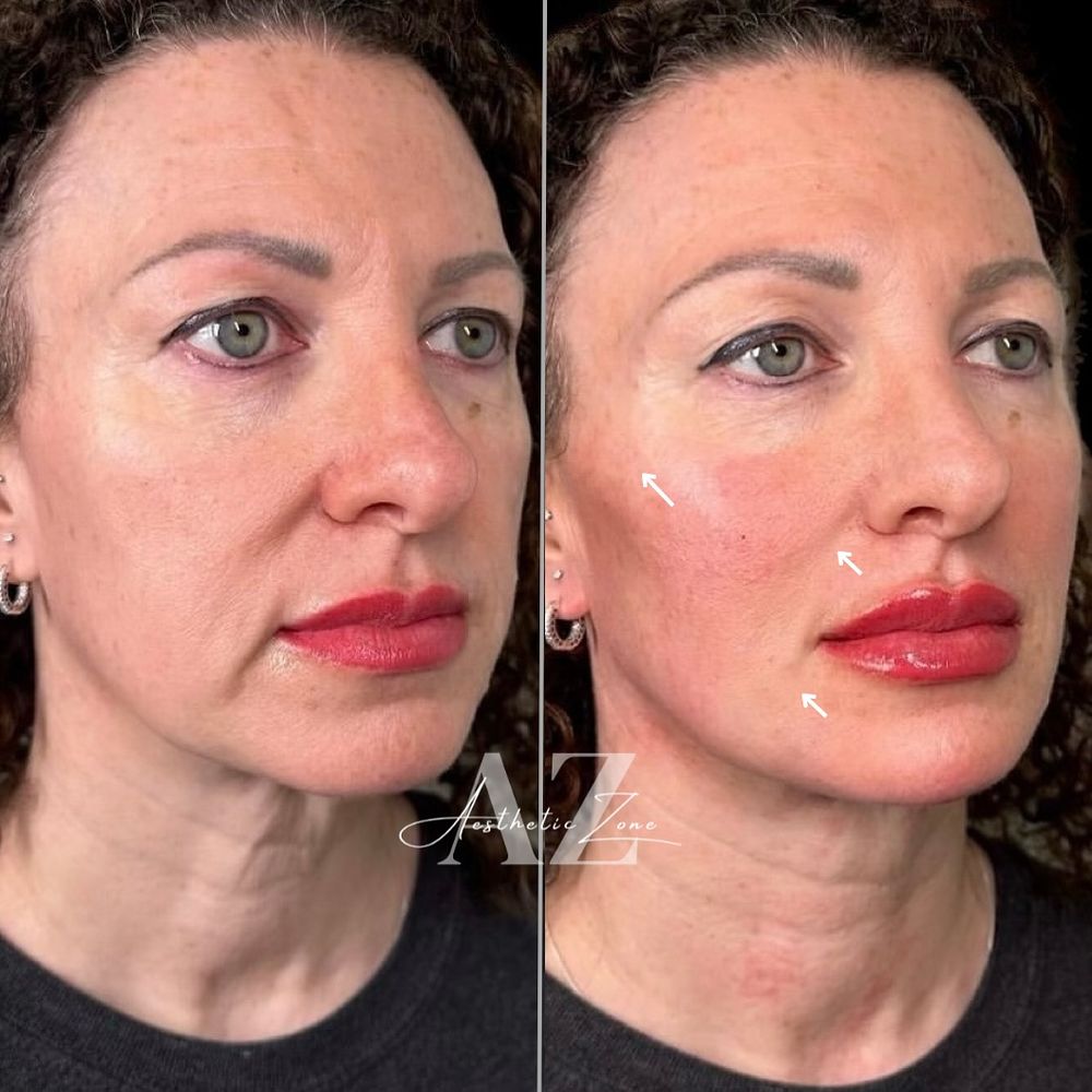 Full face rejuvenation, before and after at Aesthetic Zone