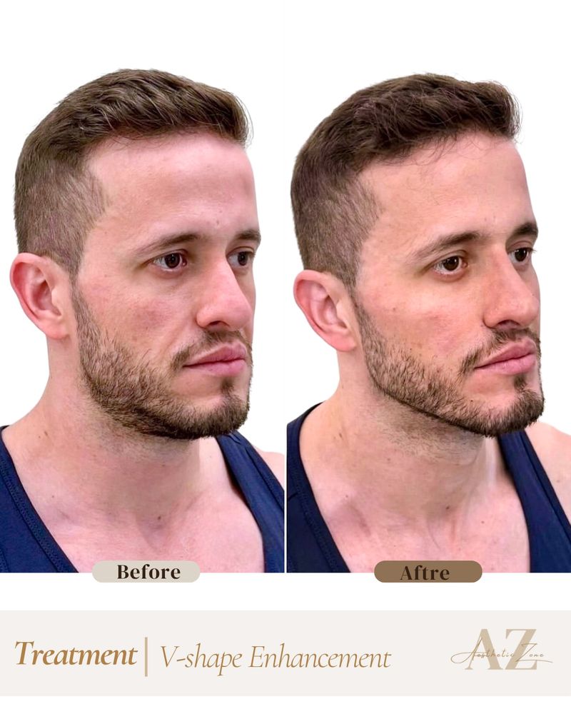 Jawline & Chin result at Aesthetic Zone