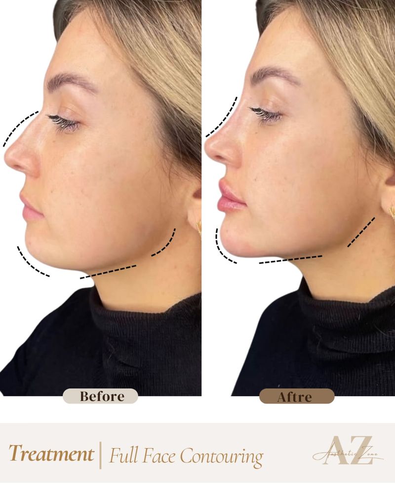 Full face contouring, before and after at Aesthetic Zone