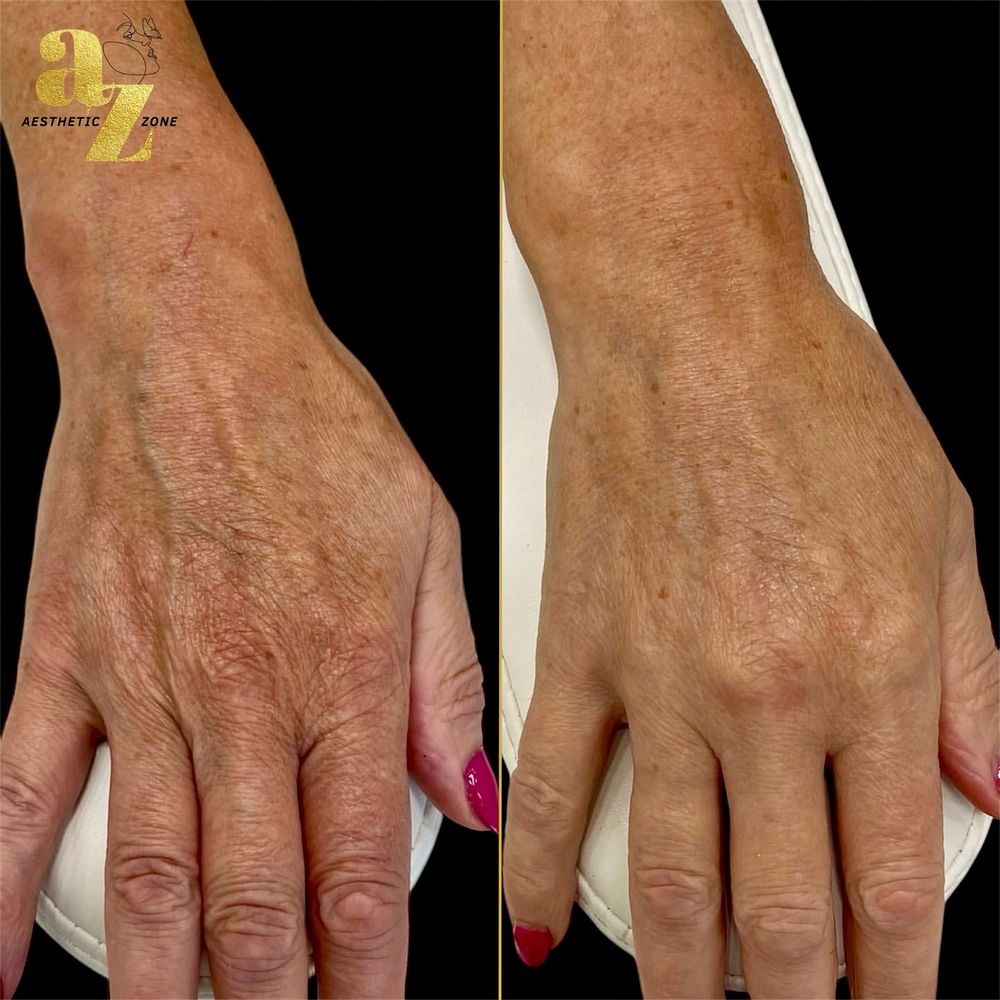 Hand rejuvenation, before and after at Aesthetic Zone
