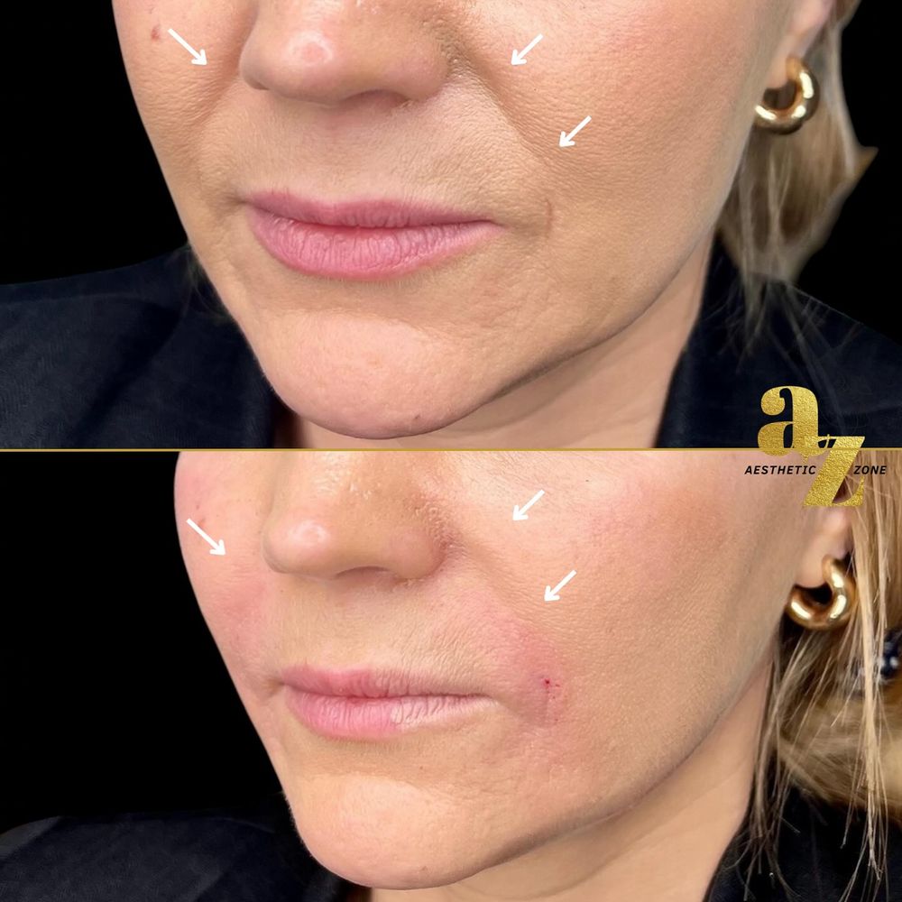 Nasolabial Folds result at Aesthetic Zone