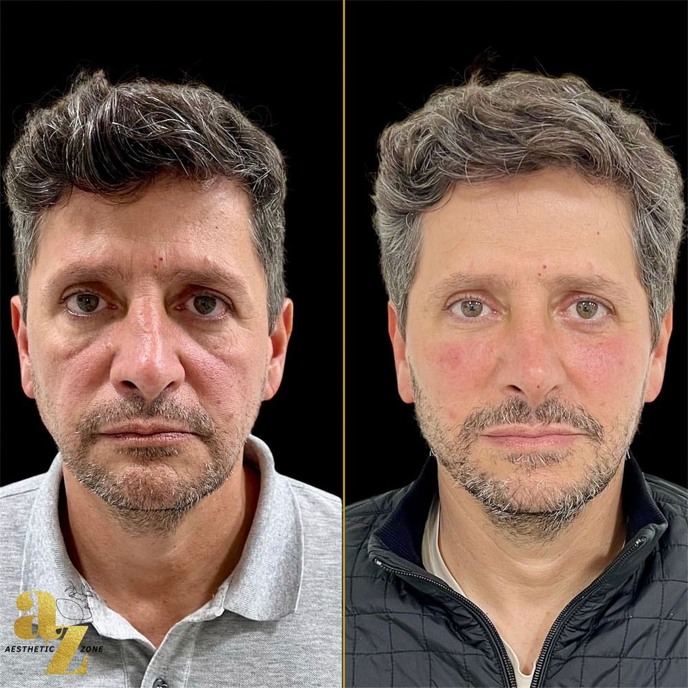 Full face, male patient, before and after at Aesthetic Zone