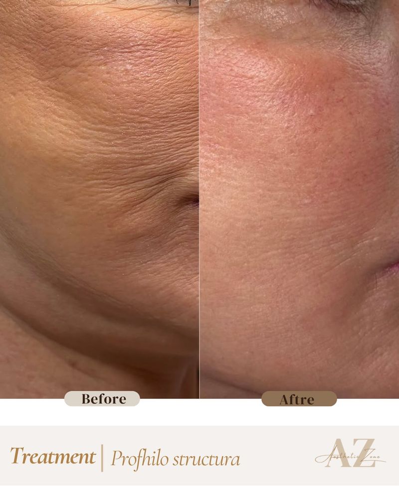 Profhilo & Skin result at Aesthetic Zone