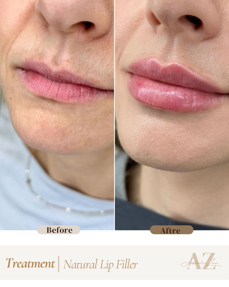 Lip Filler result at Aesthetic Zone
