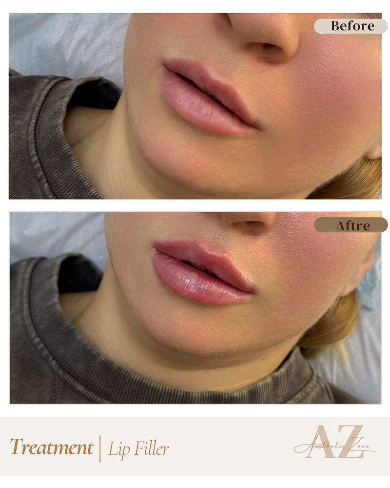 Lip filler, before and after at Aesthetic Zone
