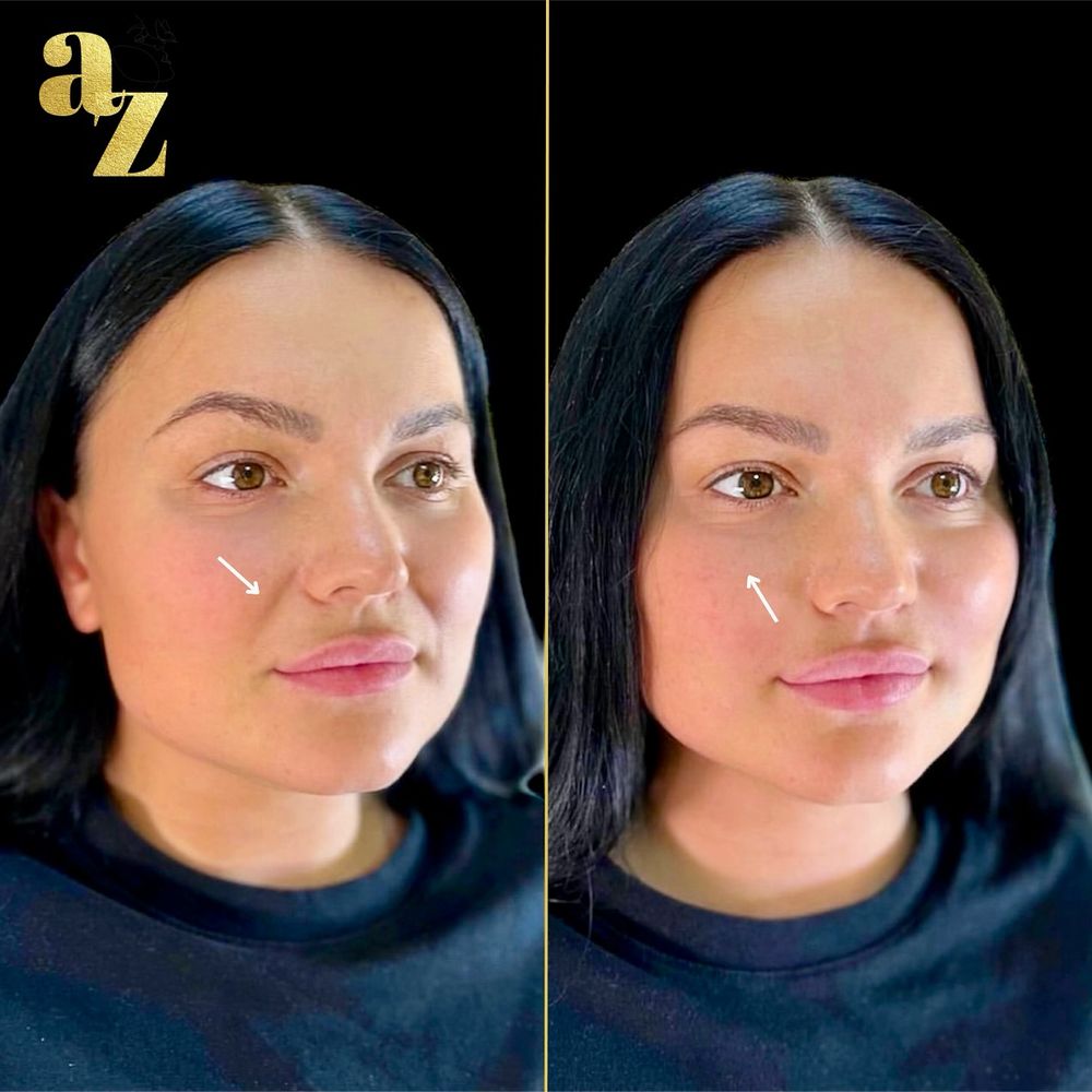 Nasolabial folds, before and after at Aesthetic Zone