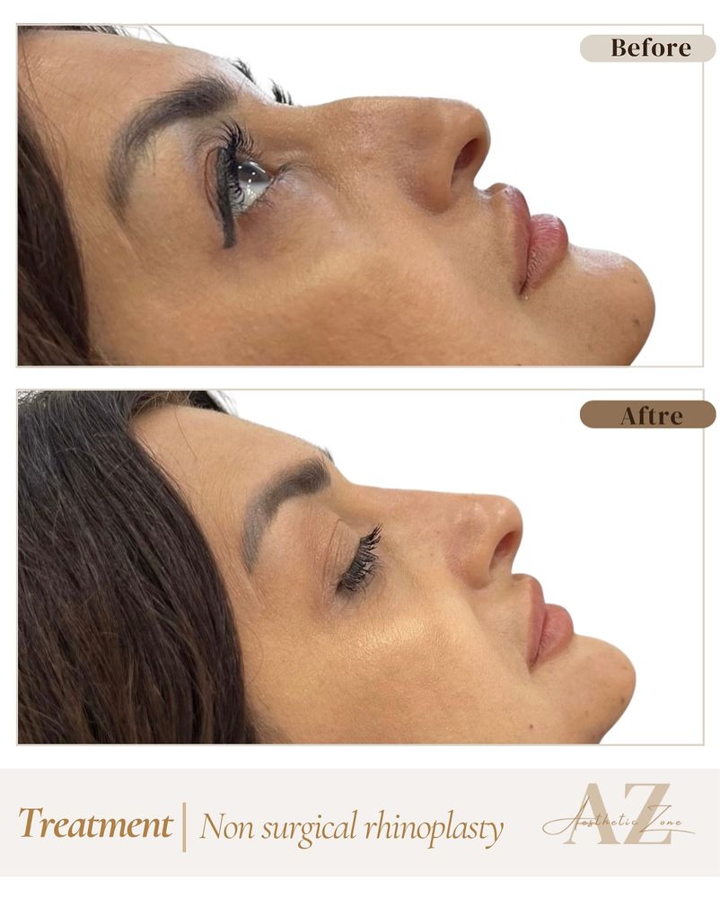 Non-surgical rhinoplasty, before and after at Aesthetic Zone