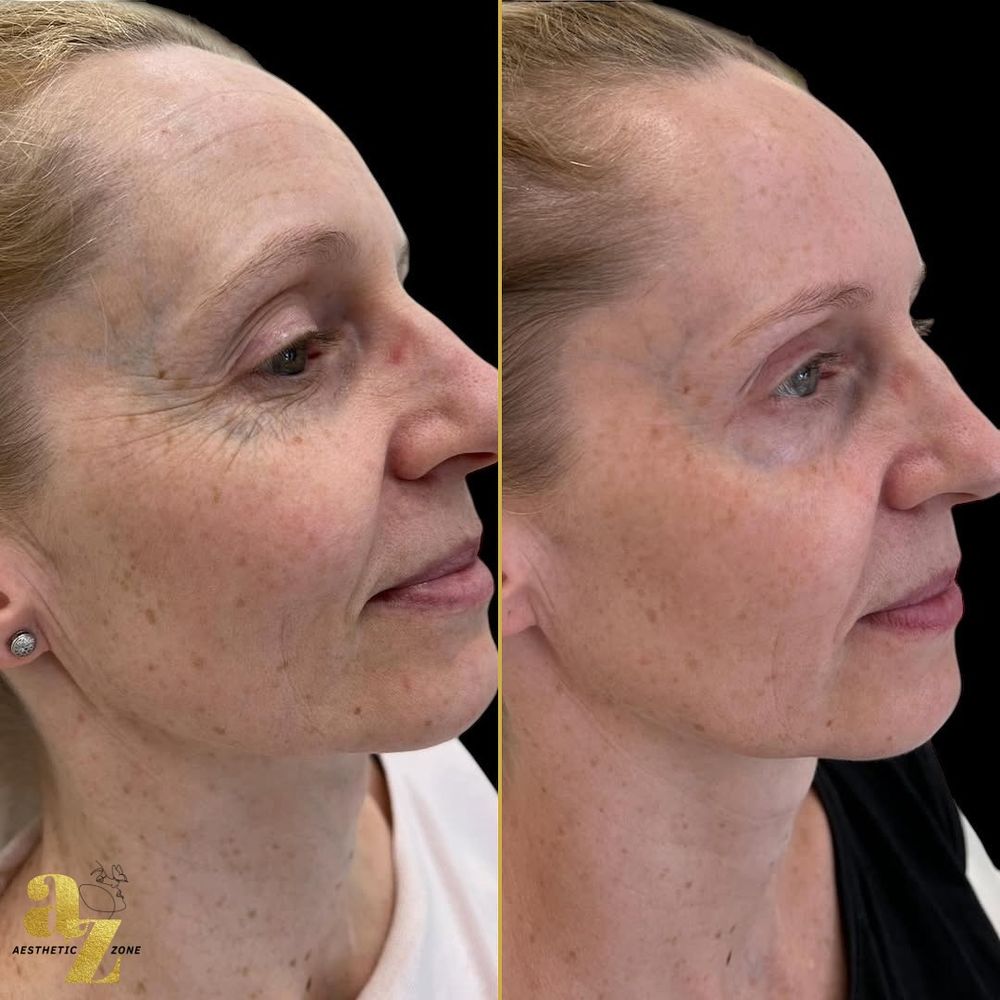 Skin rejuvenation, before and after at Aesthetic Zone