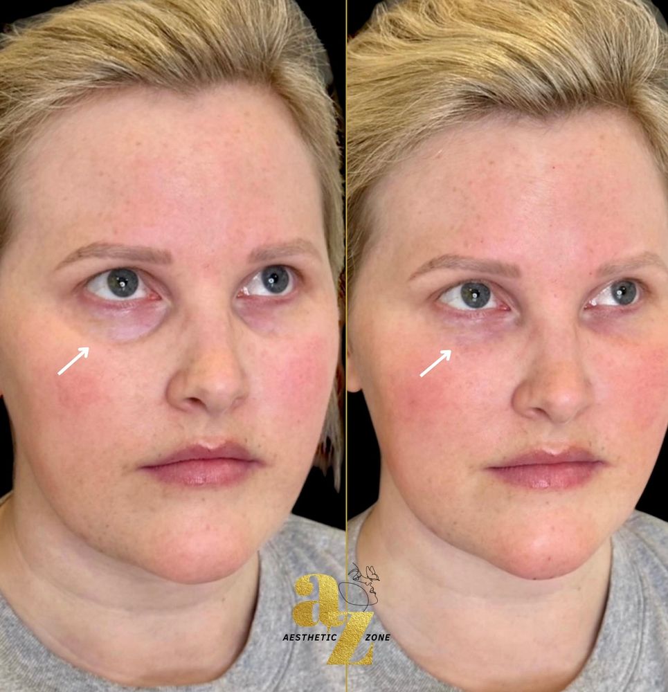 Tear trough rejuvenation, before and after at Aesthetic Zone