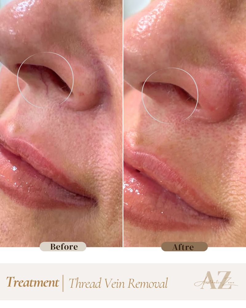 Thread Vein Removal result at Aesthetic Zone