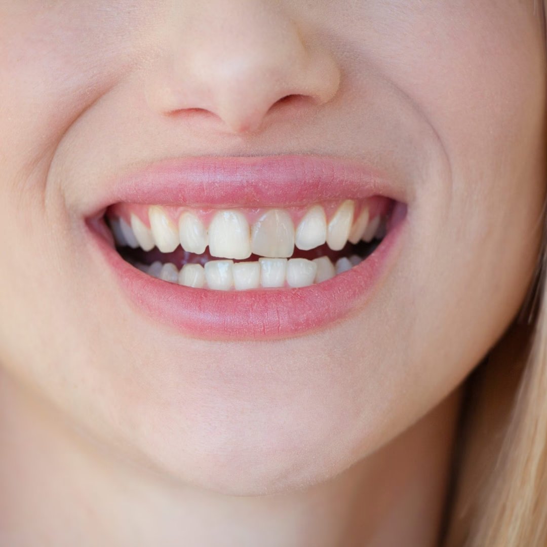 Discolouration and uneven teeth