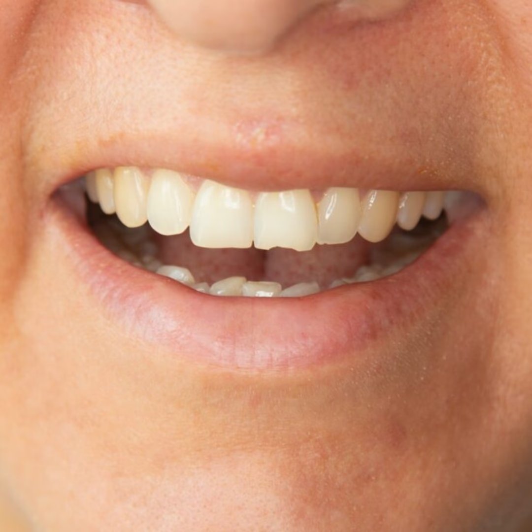 Chipped tooth before composite bonding
