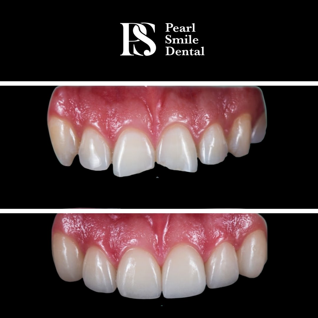 Pearl Smile Dental composite bonding before and after result