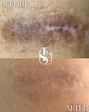 Surgical scar before and after camouflage, healed