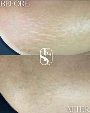 Stretch marks on the thigh before and after camouflage, healed