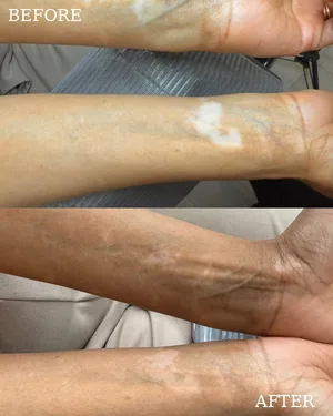 Vitiligo on the hand before and after camouflage