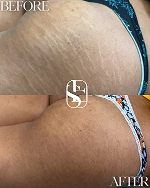 Stretch marks on the hip before and after camouflage, healed