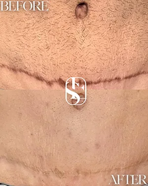 Tummy tuck scar before and after camouflage, healed