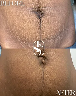 Stretch marks on the abdomen before and after camouflage, healed