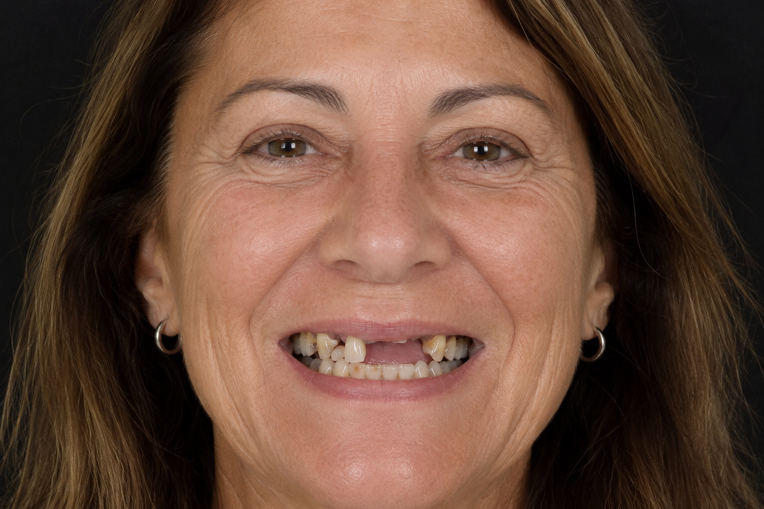 Before dental smile transformation
