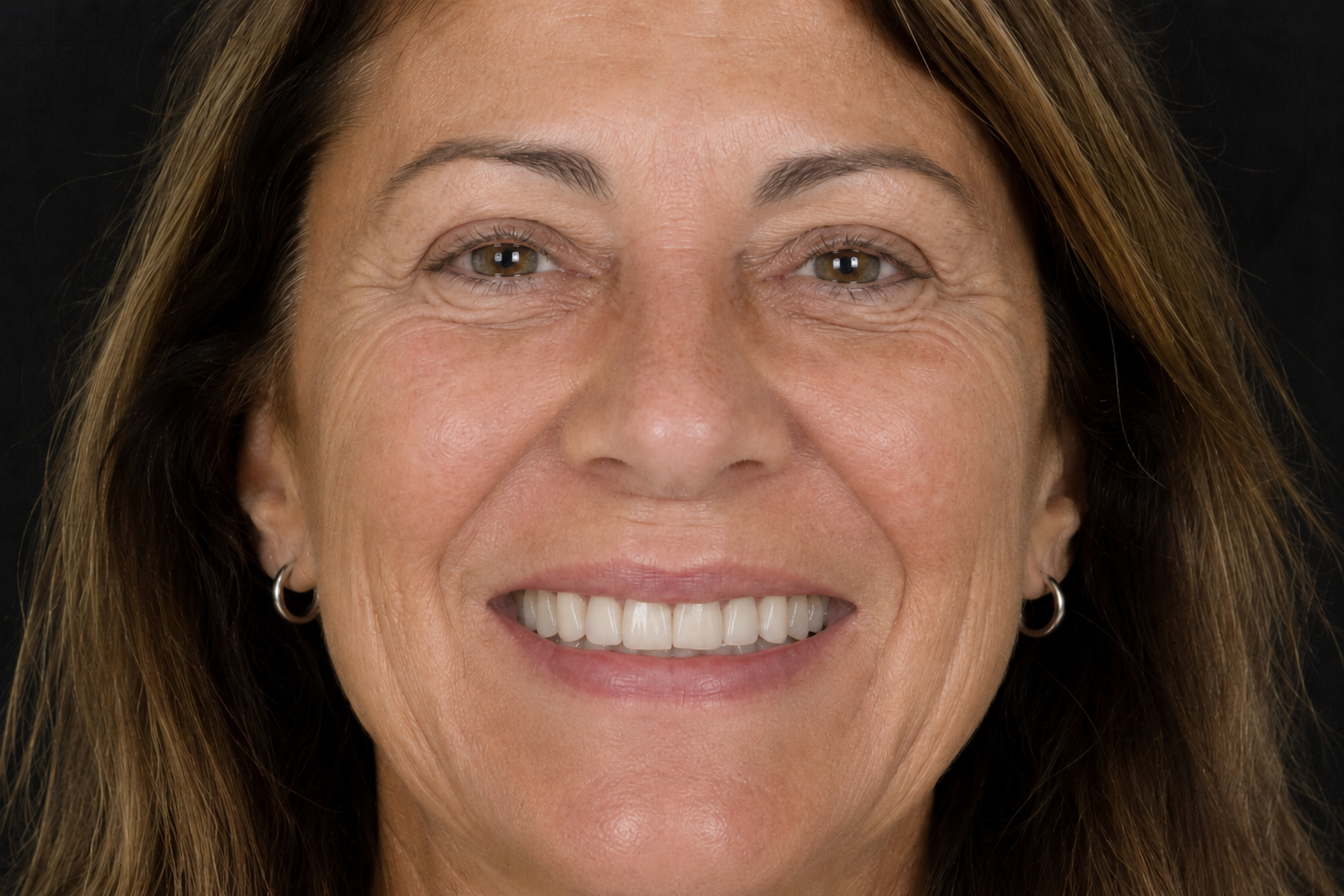 After dental smile transformation