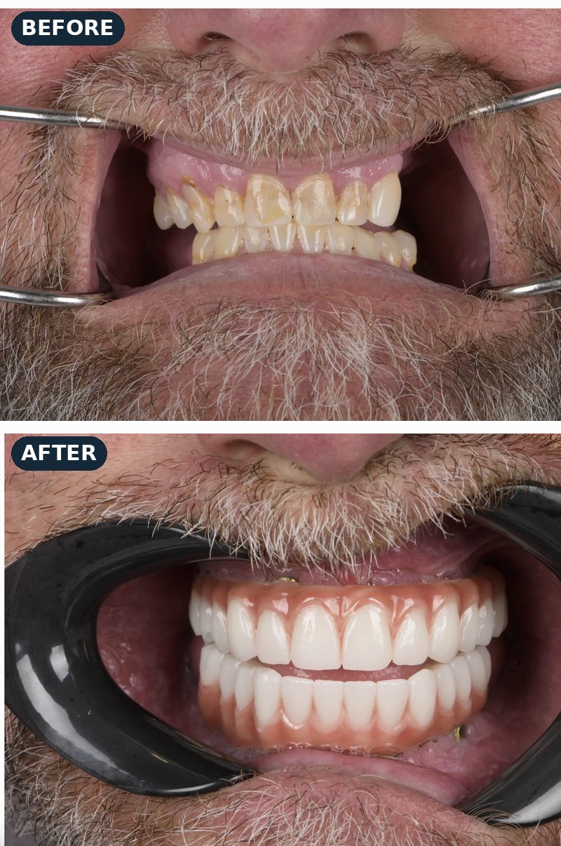 Before and after: worn, gapped teeth, then a new full upper and lower arch