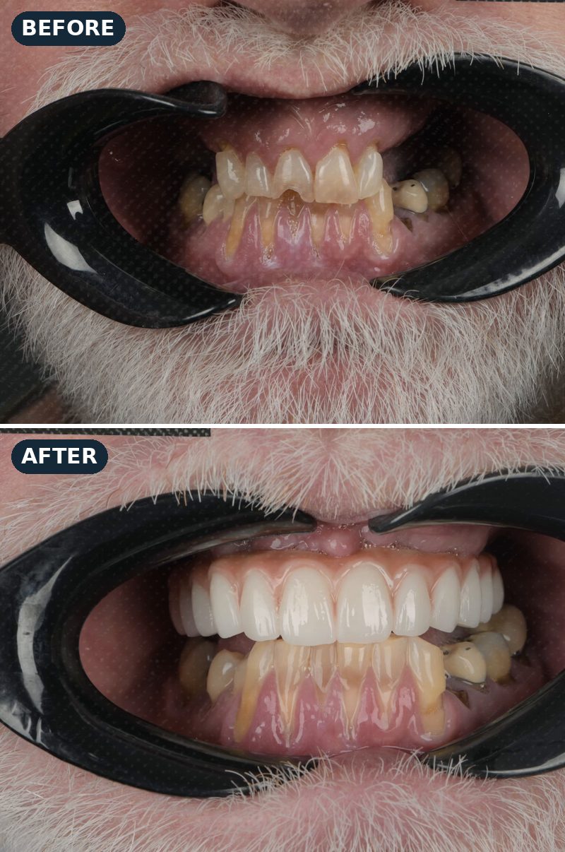 Before and after: Vic’s teeth before treatment, then his new upper teeth