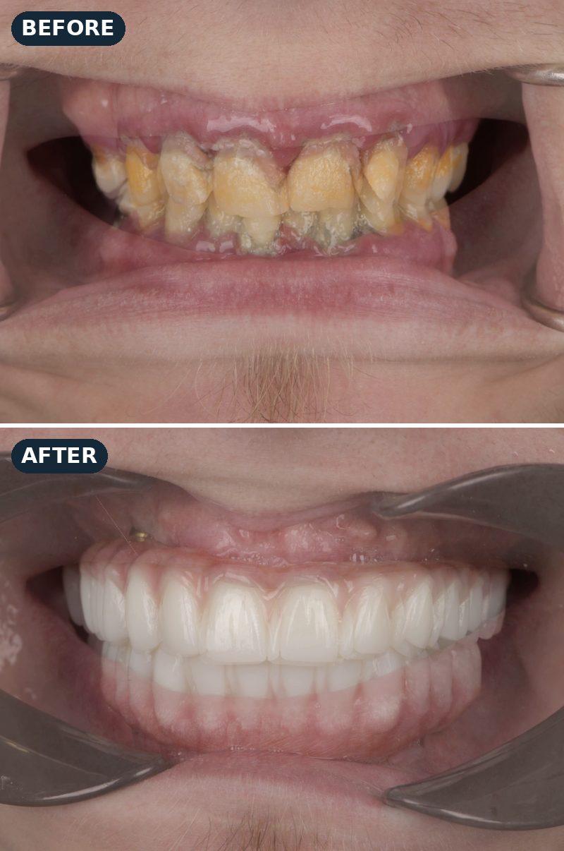 Before and after: Danny’s failing, stained teeth, then his new full-arch smile