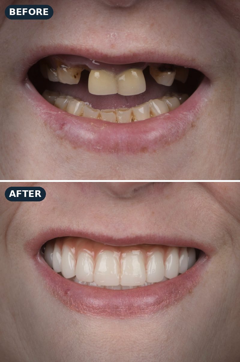 Before and after: Carolyn’s broken, stained teeth, then her new smile
