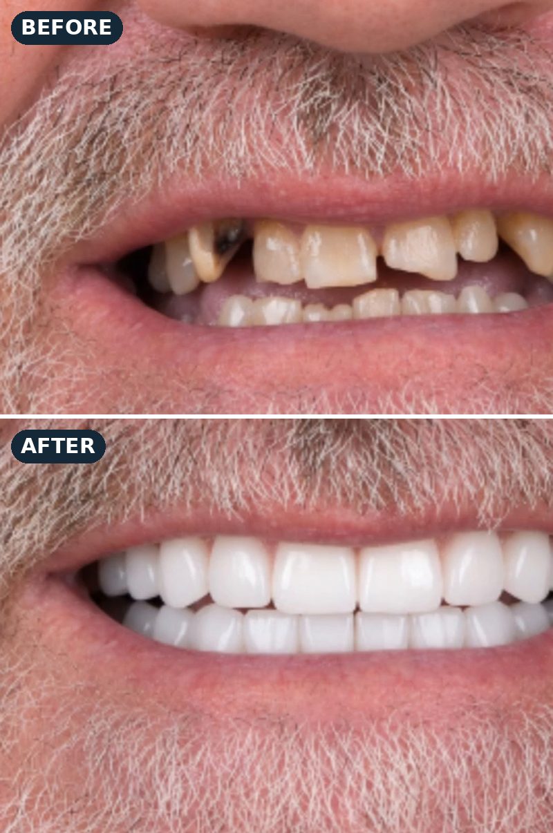 Before and after: a former upper-denture wearer’s worn, broken teeth, then his new fixed full-arch smile