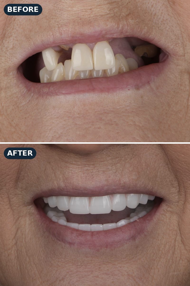 Before and after: Julie’s missing and worn teeth, then her new smile