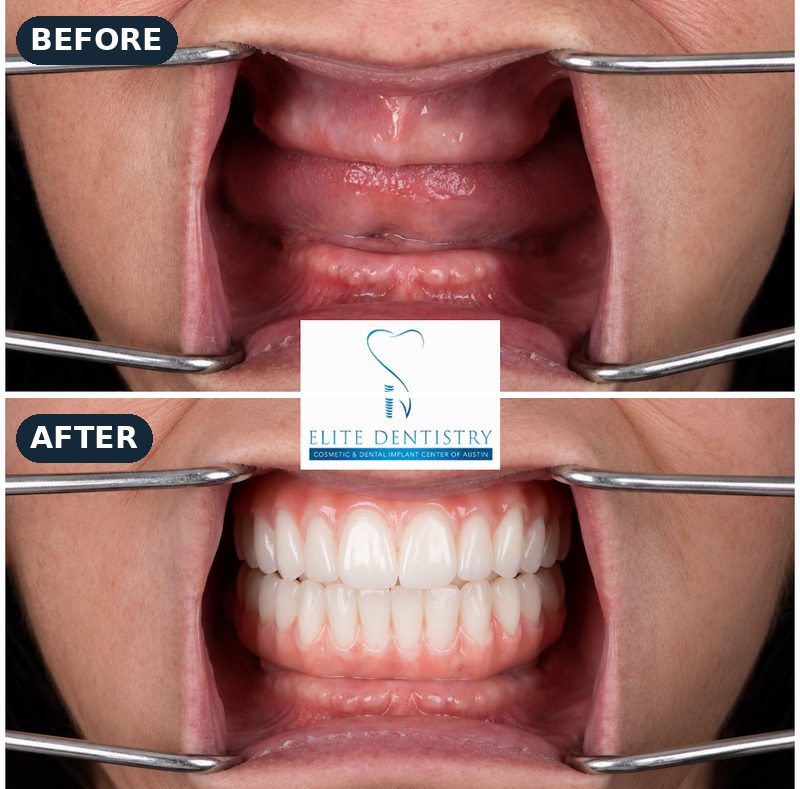 Before and after, intraoral: no remaining teeth on the upper or lower gums, then full upper and lower arches of zirconia teeth