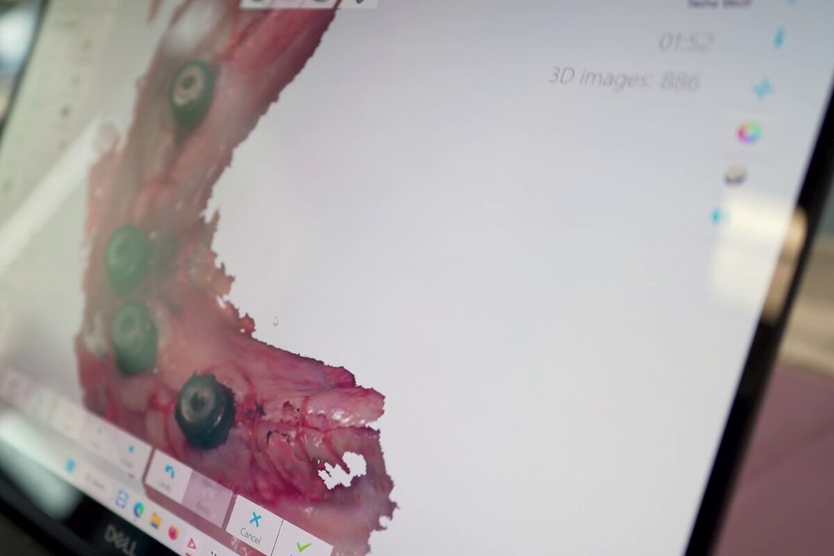 A 3D digital model of a patient’s jaw on a screen at Elite Dentistry