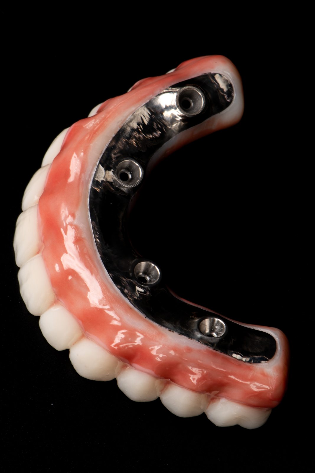 Underside view of a full-arch prosthesis showing its internal framework and implant connection points