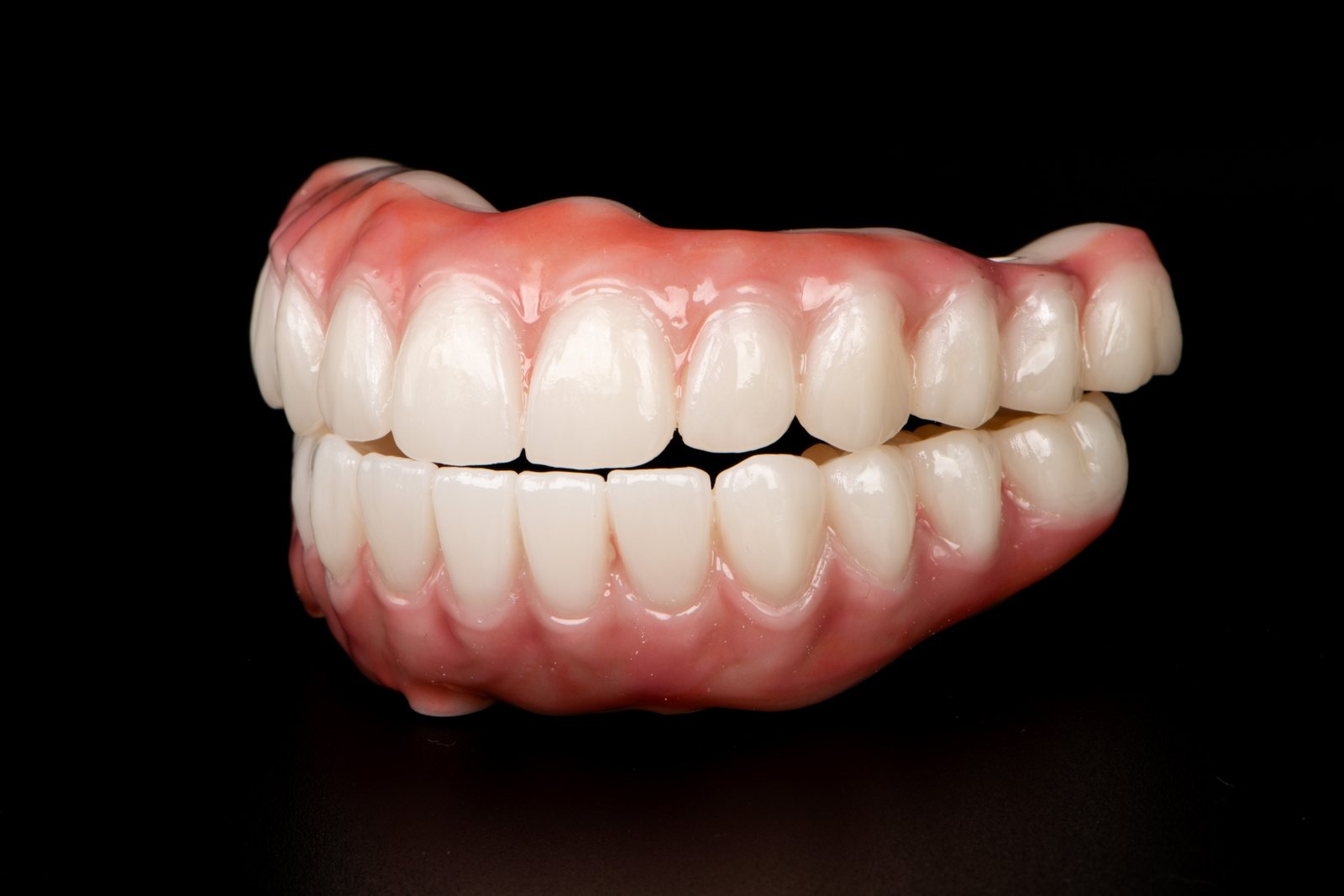 Front and side view of a complete upper and lower full-arch dental prosthesis made in Elite Dentistry’s lab
