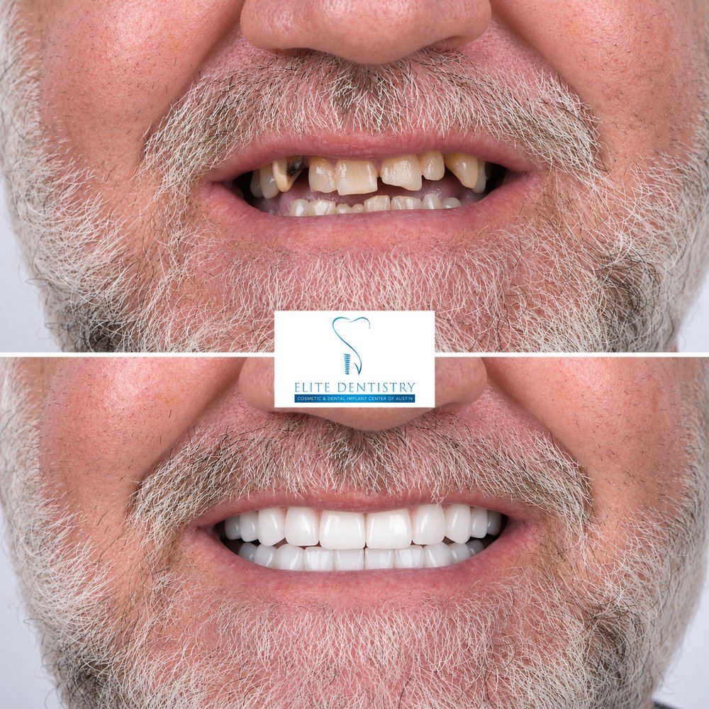 Close-up before and after of a male patient’s smile: worn, discolored, missing teeth before, and a full row of new teeth after